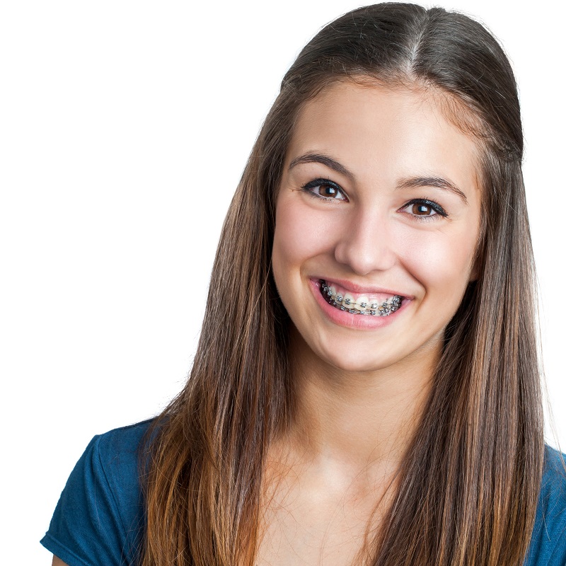 How Long Will You Be in Braces? Fisher Orthodontics